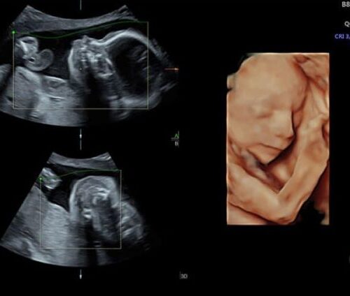 voluson-s8-ge-ultraschall-gynaekologie-foetus